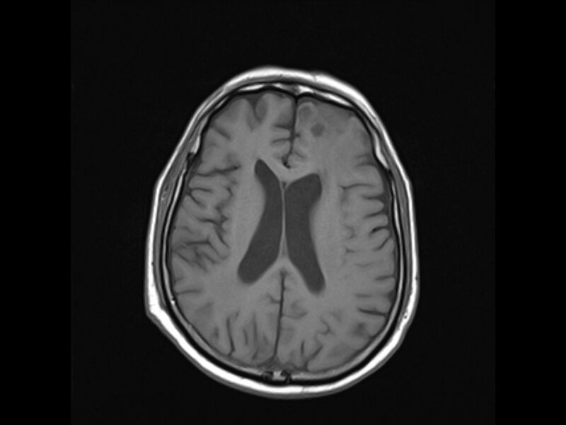 File:Brain metastases from renal cell carcinoma (Radiopaedia 42222-45297 Axial T1 16).jpg