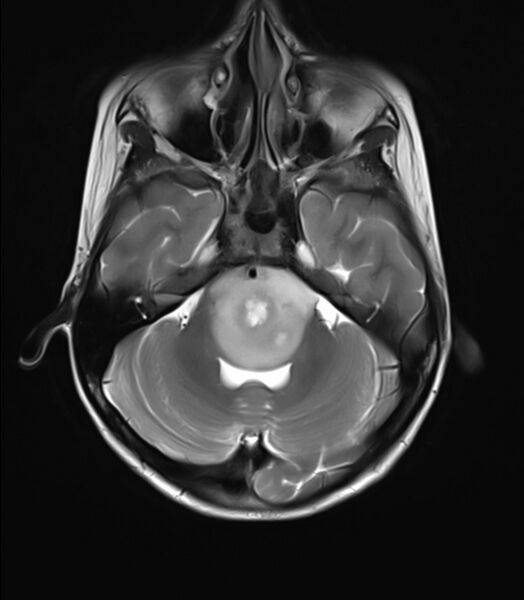 File:Brainstem glioma (Radiopaedia 70548-80674 Axial T2 7).jpg