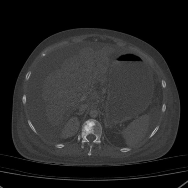 File:Breast cancer metastases - hepatic and skeletal (Radiopaedia 34201-35461 Axial bone window 42).jpg