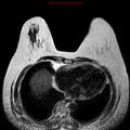 Breast carcinoma (multicentric multifocal in mammary Paget disease) (Radiopaedia 50966-56512 Axial T2 3).jpg