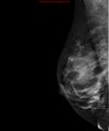 Breast lipoma (Radiopaedia 16321-16004 MLO 1).jpg