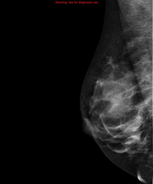 File:Breast lipoma (Radiopaedia 16321-16004 MLO 1).jpg