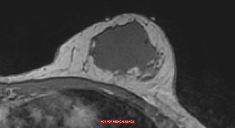 File:Breast lymphoma (MRI) (Radiopaedia 34999-36498 Axial T1 10).jpg