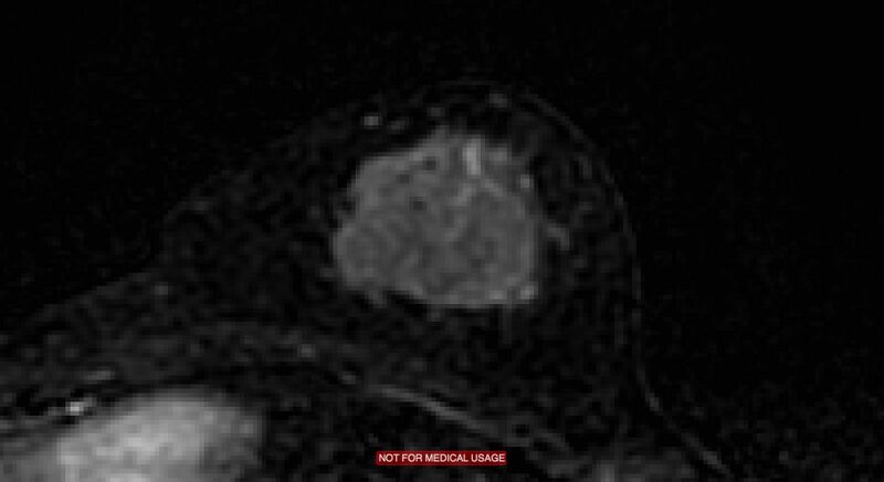 File:Breast lymphoma (MRI) (Radiopaedia 34999-36498 C 12).jpg