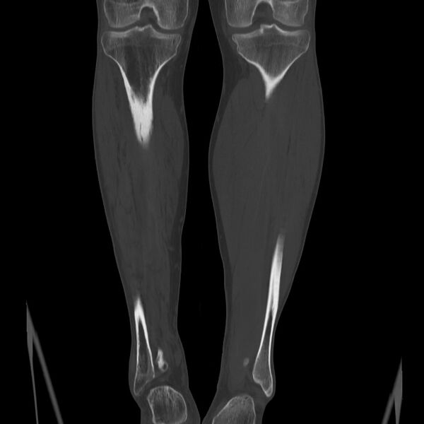 File:Brodie abscess - tibia (Radiopaedia 66028-75204 Coronal bone window 46).jpg