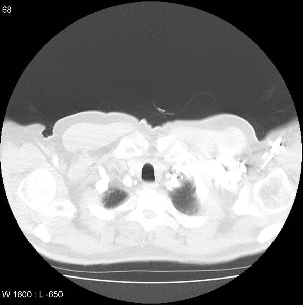 File:Bronchial carcinoid tumor with right lower lobe collapse (Radiopaedia 29060-29422 B 6).jpg