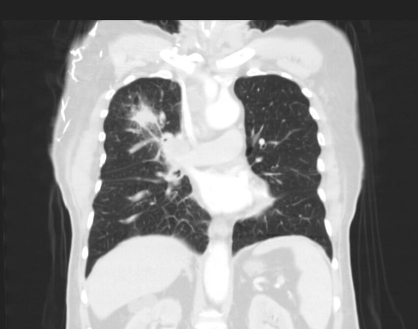 Bronchogenic carcinoma with lymphangitic spread (Radiopaedia 29002-29357 Coronal lung window 33).jpg
