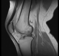 Bucket handle tear - medial meniscus (Radiopaedia 24900-25163 Sagittal T2 10).png