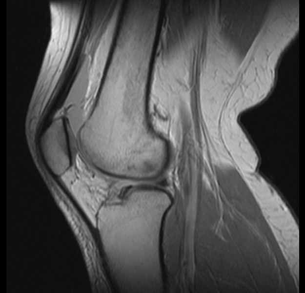 File:Bucket handle tear - medial meniscus (Radiopaedia 24900-25163 Sagittal T2 10).png