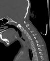 Butterfly vertebra (Radiopaedia 77903-90209 Sagittal bone window 39).jpg