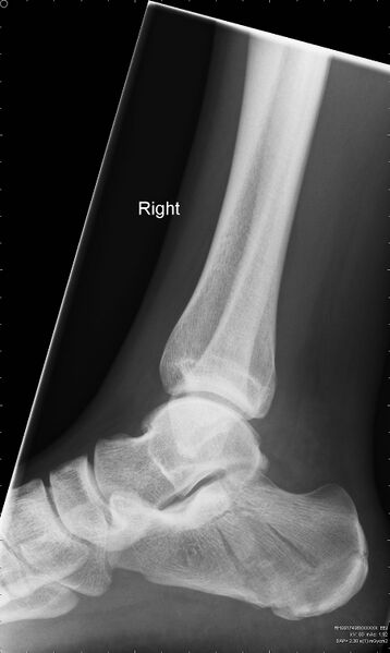 File:Calcaneal fracture (Radiopaedia 46201-50592 Lateral 1).jpg