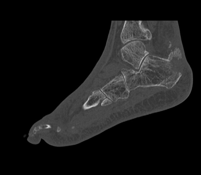 File:Calcaneal tuberosity avulsion fracture (Radiopaedia 22649-22668 Sagittal bone window 15).jpg