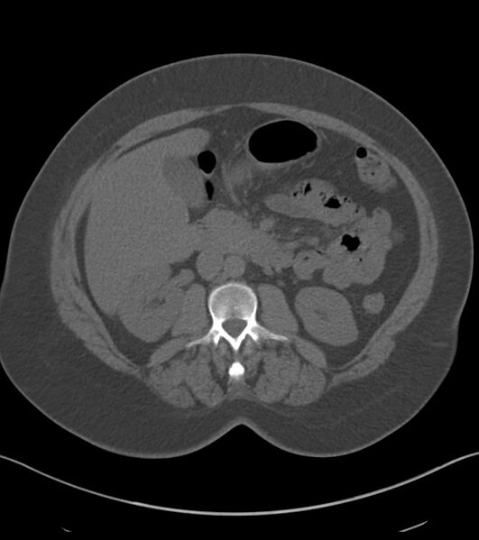 File:Calcified hepatic hydatid cyst (Radiopaedia 81127-94738 Axial non-contrast 43).jpg