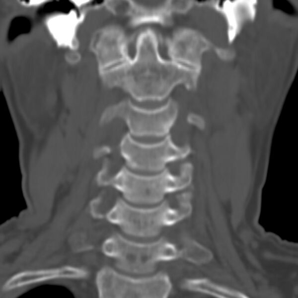 File:Calcified meningioma - cervical canal (Radiopaedia 70136-80171 Coronal bone window 4).jpg