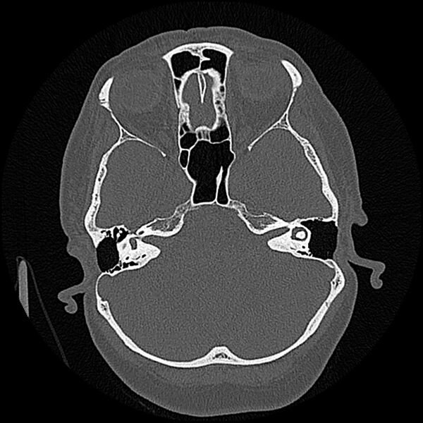 File:Canal up mastoidectomy (Radiopaedia 78108-90638 Axial bone window 83).jpg
