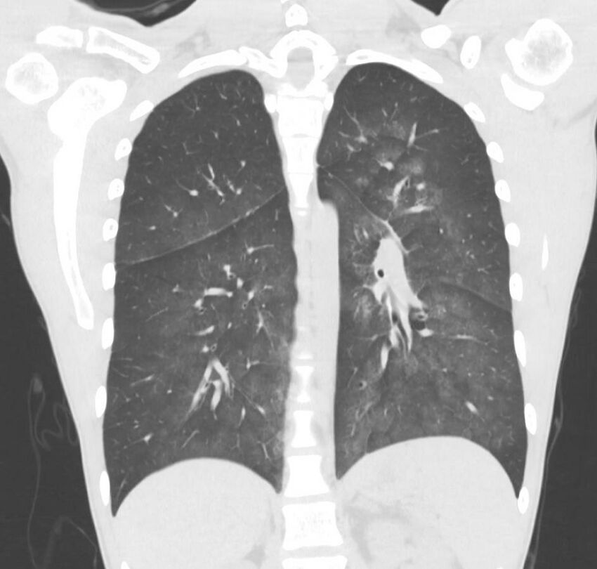 Cannabis-induced diffuse alveolar hemorrhage (Radiopaedia 89834-106946 Coronal lung window 32).jpg