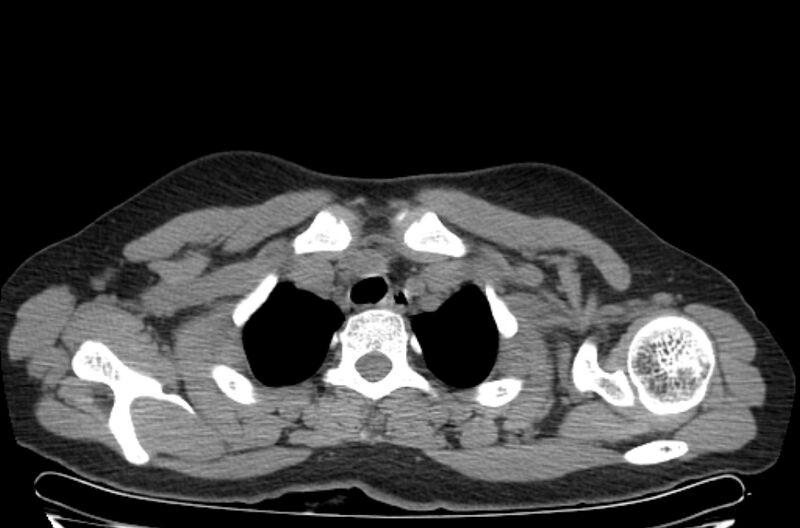 File:Cannonball metastases - uterine choriocarcinoma (Radiopaedia 70137-80173 Axial non-contrast 5).jpg