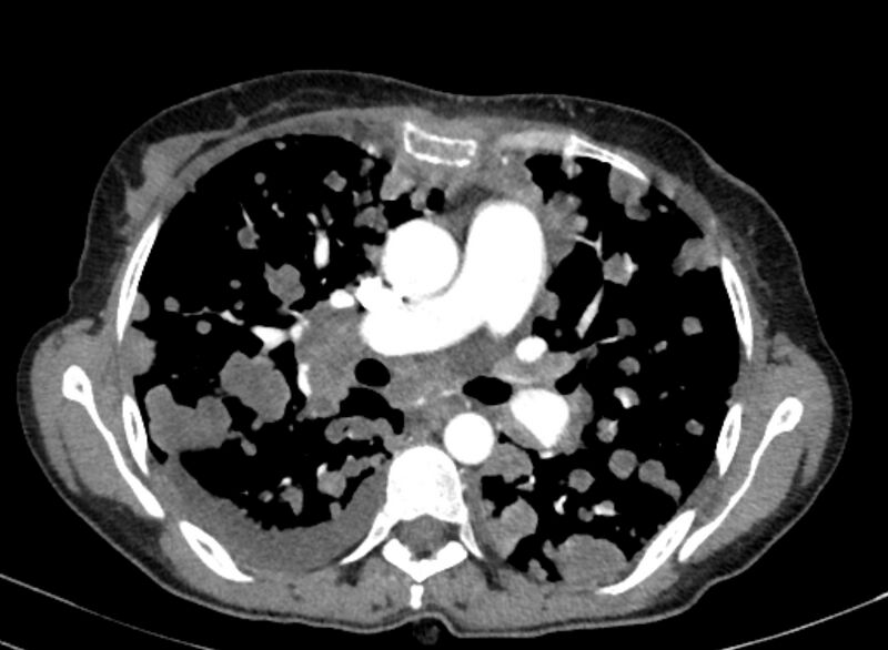 File:Cannonball metastases from breast cancer (Radiopaedia 91024-108569 A 55).jpg