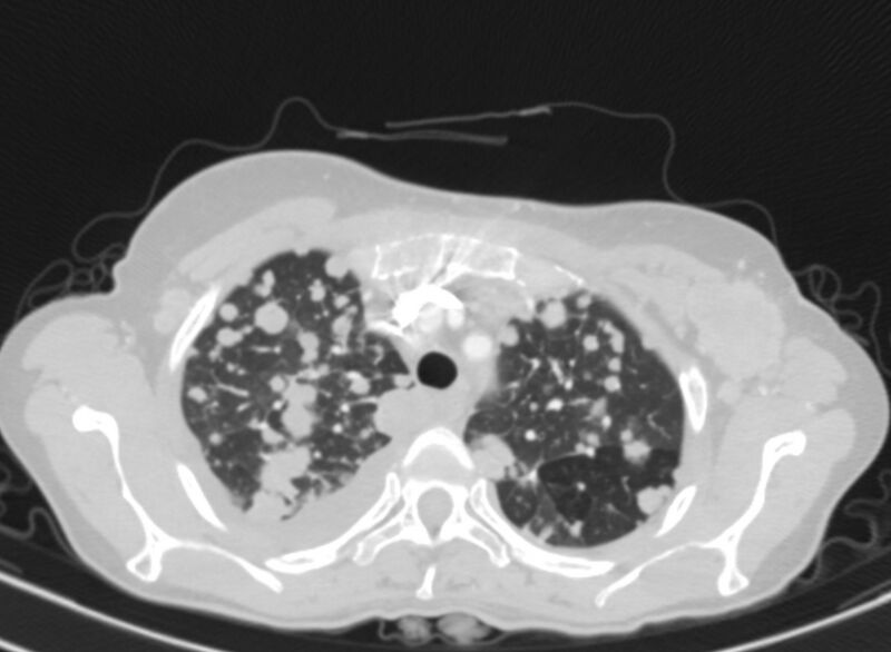 File:Cannonball metastases from breast cancer (Radiopaedia 91024-108569 Axial lung window 18).jpg