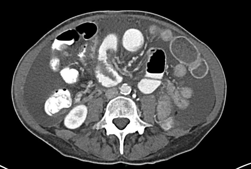 Carcinoid mesenteric tumor complicated by chylous ascites (Radiopaedia 76312-87953 A 43).jpg