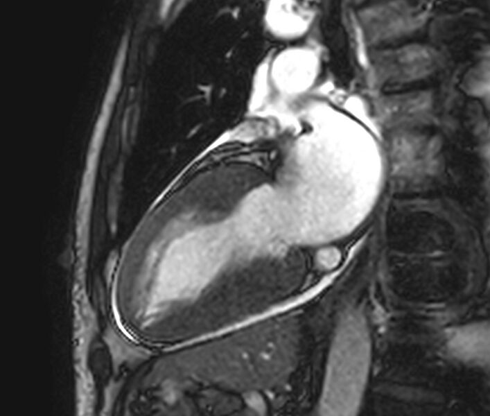 File:Cardiac amyloidosis (Radiopaedia 39736-42124 B 22).jpg