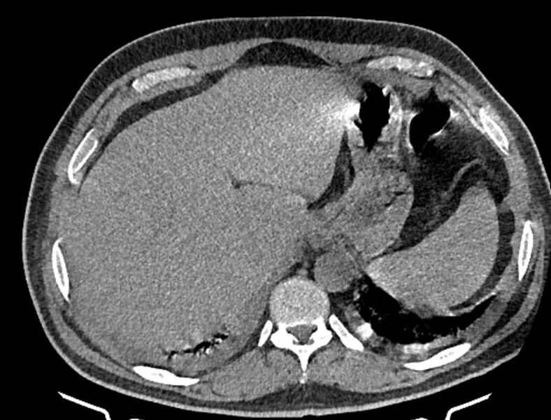 File:Cardiogenic pulmonary edema (Radiopaedia 68180-77678 Axial non-contrast 52).jpg