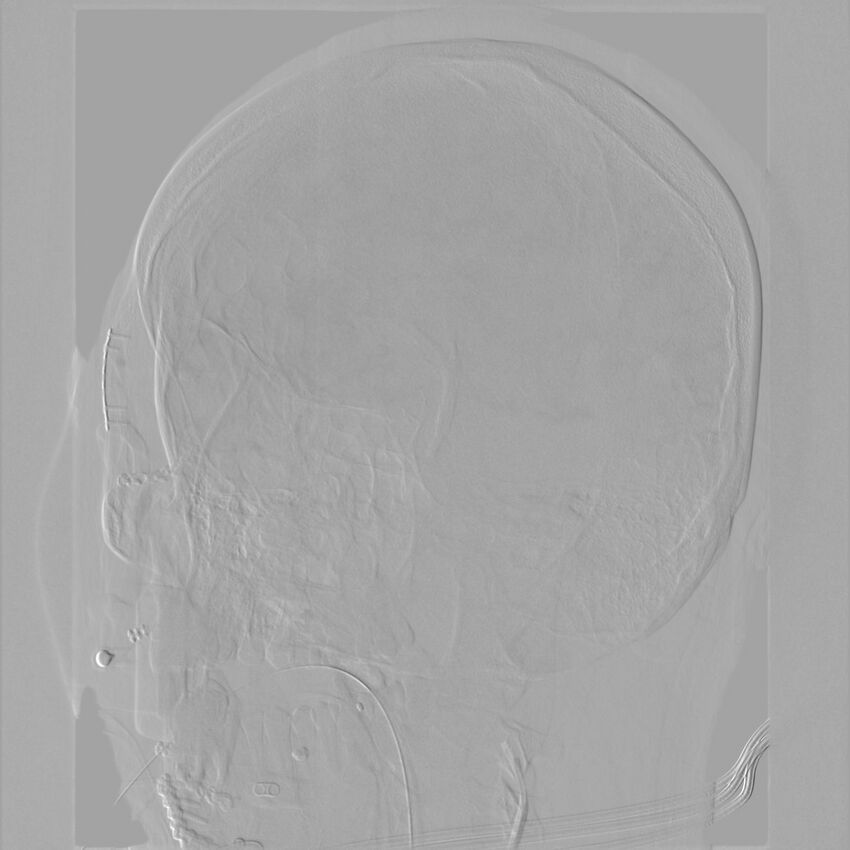 Caroticocavernous fistula - direct (Radiopaedia 61660-69666 Oblique Left ICA 41).jpg