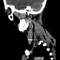 Carotid body tumor (Radiopaedia 27890-28124 C 3).jpg
