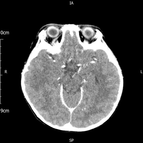 File:Cavernous sinus thrombosis (Radiopaedia 79414-92510 Axial Brain 90).jpg