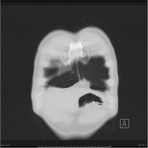 File:Cavitating lung cancer (Radiopaedia 25796-25945 lung window 1).jpg