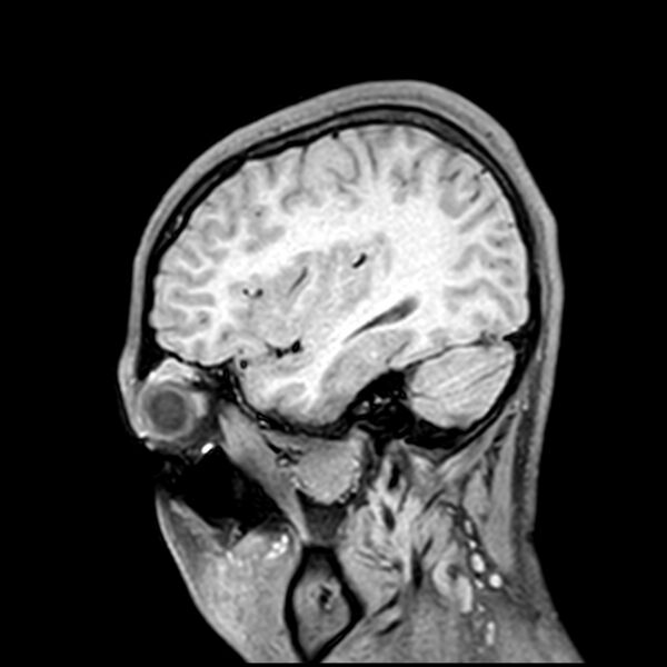 File:Central neurocytoma (Radiopaedia 79320-92380 Sagittal T1 68).jpg