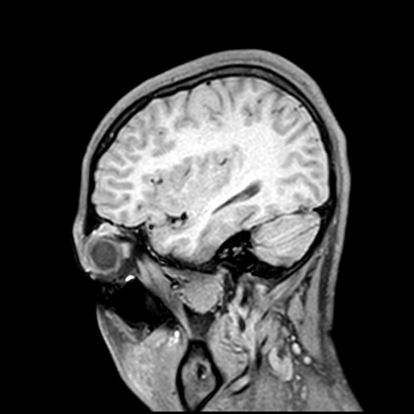 File:Central neurocytoma (Radiopaedia 79320-92380 Sagittal T1 69).jpg