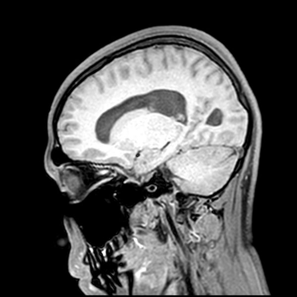 File:Central neurocytoma (Radiopaedia 79320-92380 Sagittal T1 97).jpg