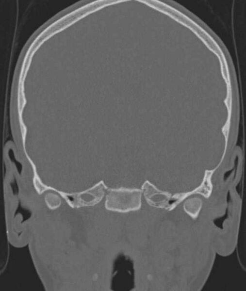 File:Cerebellar abscess (Radiopaedia 73727-84527 Coronal bone window 86).jpg
