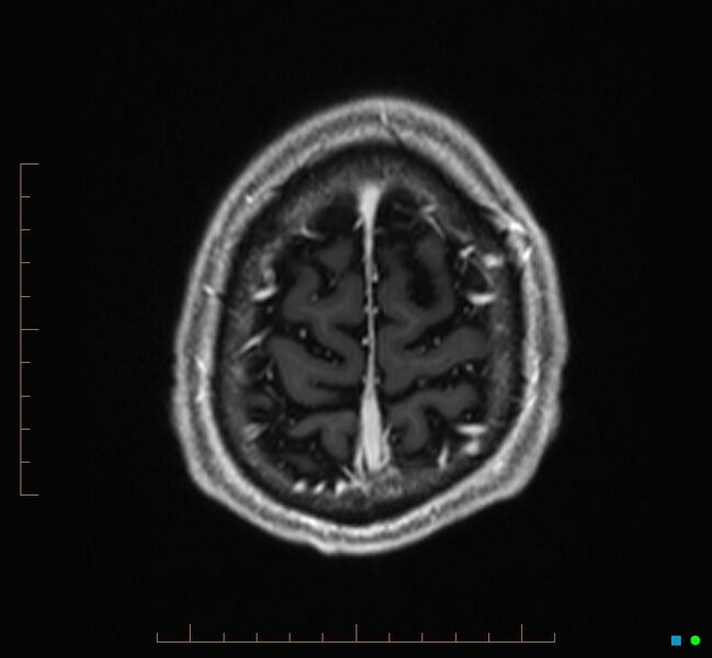 File:Cerebellar gangliocytoma (Radiopaedia 65377-74422 Axial T1 C+ 131).jpg