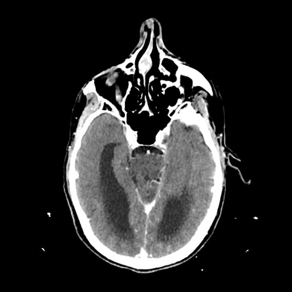 File:Cerebellar metastasis - lung tumor (Radiopaedia 69317-79145 Axial with contrast 16).jpg
