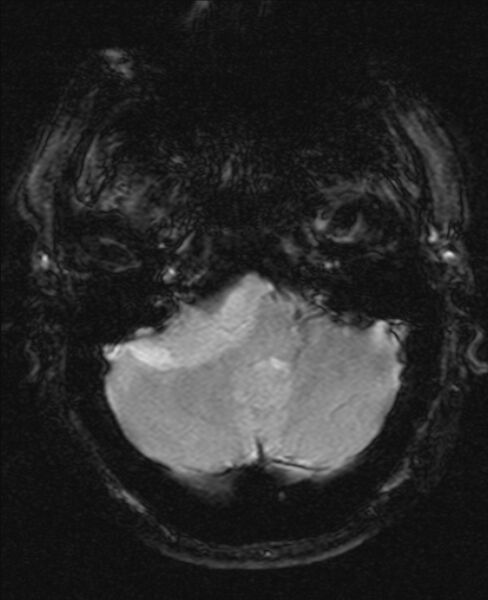 File:Cerebellopontine angle meningioma (Radiopaedia 24459-24764 Axial Gradient Echo 4).jpg