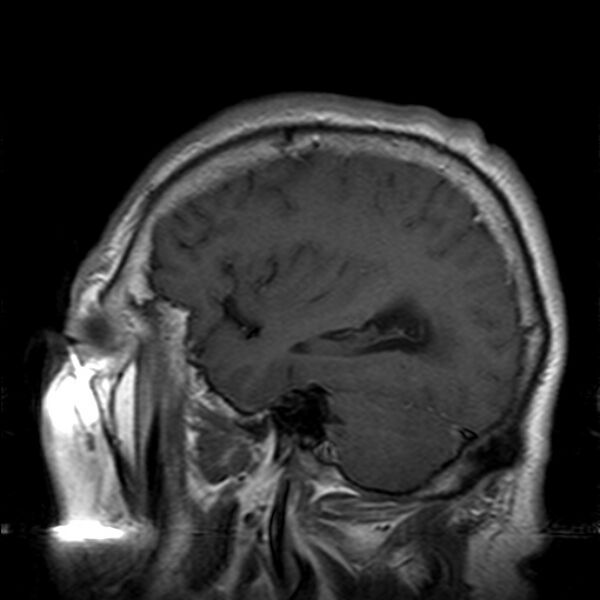 File:Cerebellopontine angle meningioma (Radiopaedia 24459-24764 Sagittal T1 C+ 20).jpg