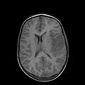 Cerebral abscess post cardiac surgery (Radiopaedia 27244-27420 Axial T1 15).jpg