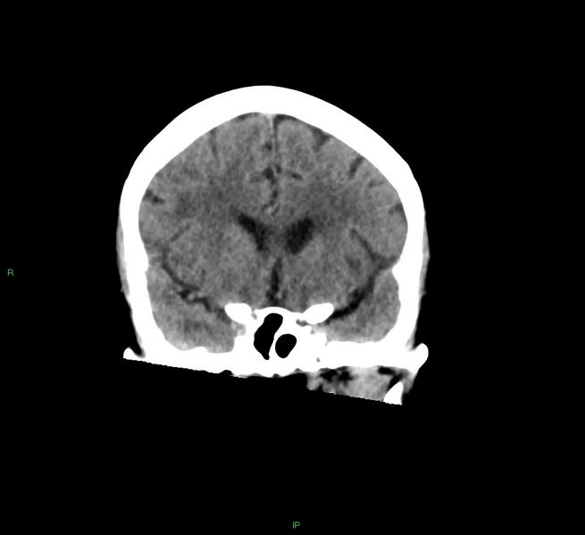 File:Cerebral amyloid angiopathy-associated lobar intracerebral hemorrhage (Radiopaedia 58378-65516 Coronal non-contrast 41).jpg