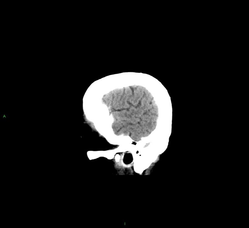 Cerebral amyloid angiopathy-associated lobar intracerebral hemorrhage (Radiopaedia 58529-65681 B 6).jpg