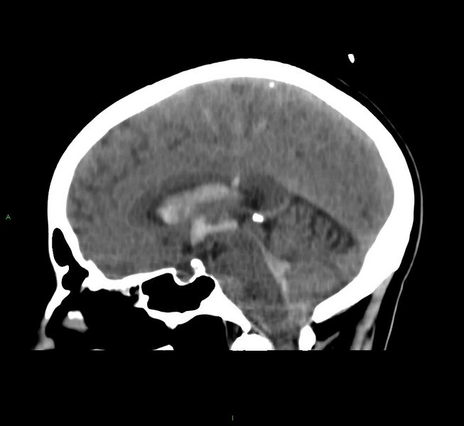 File:Cerebral amyloid angiopathy-associated lobar intracerebral hemorrhage (Radiopaedia 58566-65730 C 26).jpg