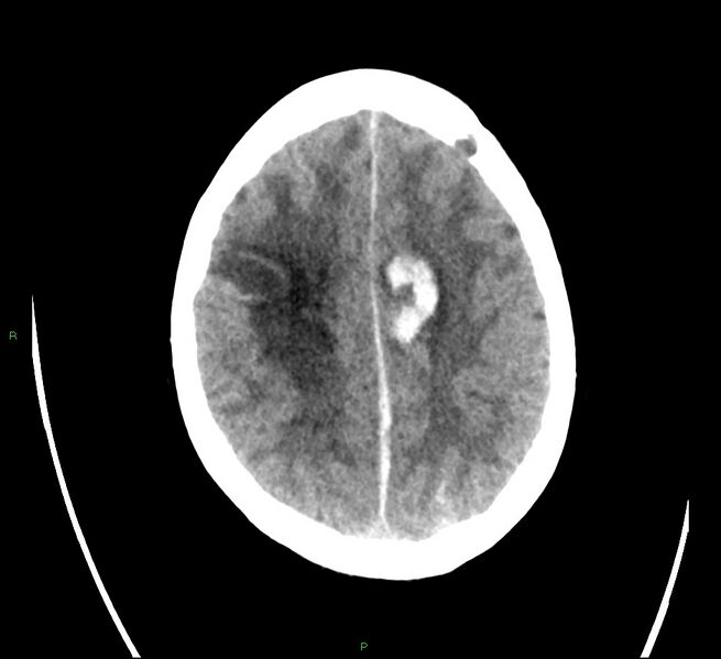 File:Cerebral amyloid angiopathy-associated lobar intracerebral hemorrhage (Radiopaedia 58566-65731 Axial non-contrast 19).jpg