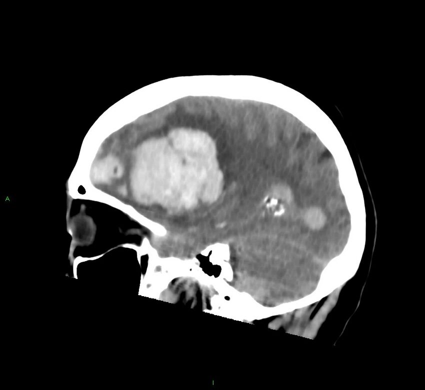 Cerebral amyloid angiopathy-associated lobar intracerebral hemorrhage (Radiopaedia 58752-65973 C 35).jpg