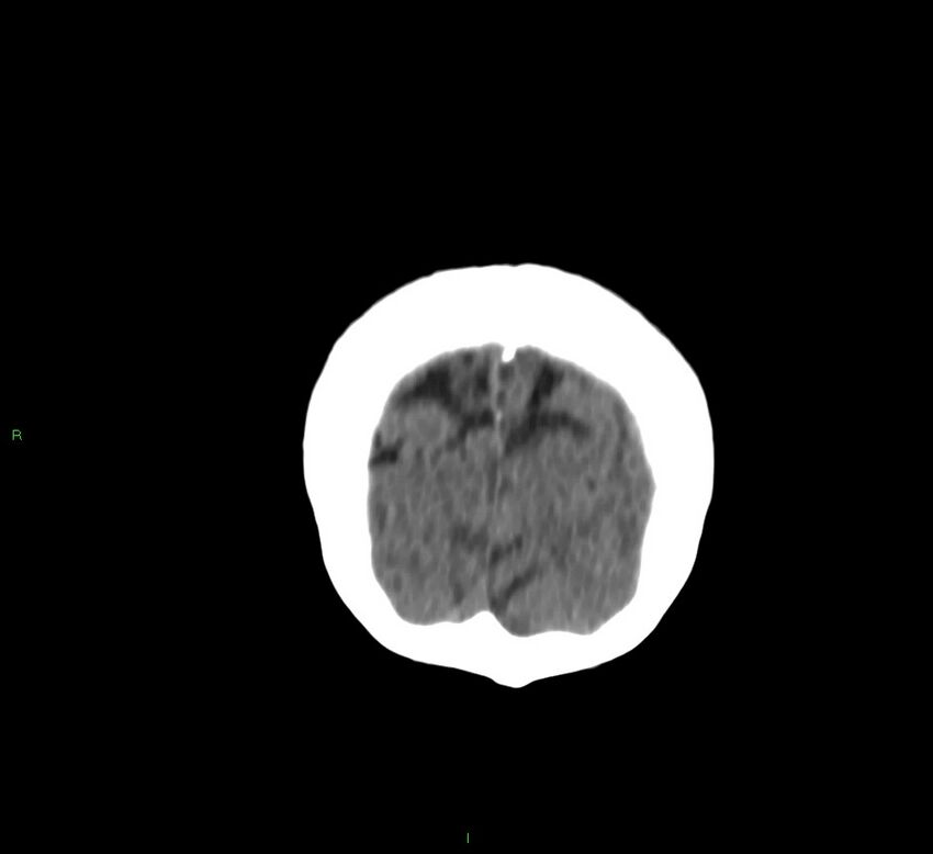 Cerebral amyloid angiopathy-associated lobar intracerebral hemorrhage (Radiopaedia 58757-65978 Coronal non-contrast 10).jpg