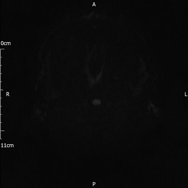 File:Cerebral amyloid angiopathy related inflammation (Radiopaedia 72772-83415 Axial DWI 47).jpg