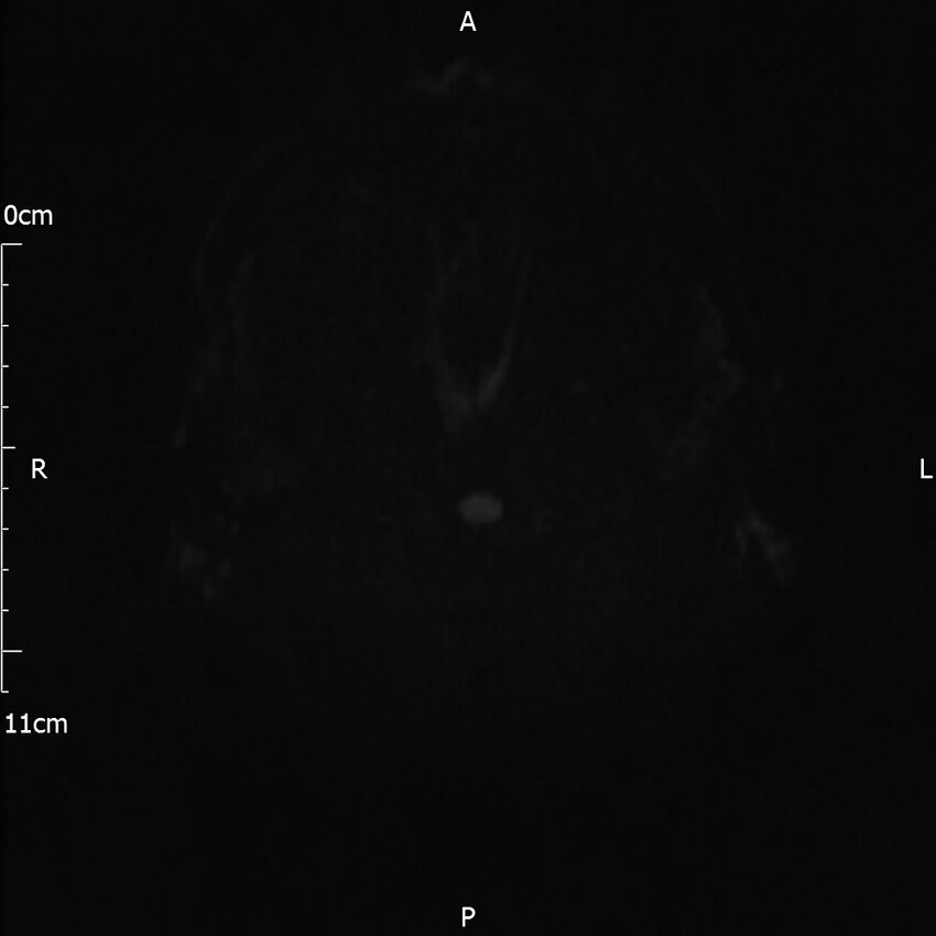 Cerebral amyloid angiopathy related inflammation (Radiopaedia 72772-83415 Axial DWI 47).jpg