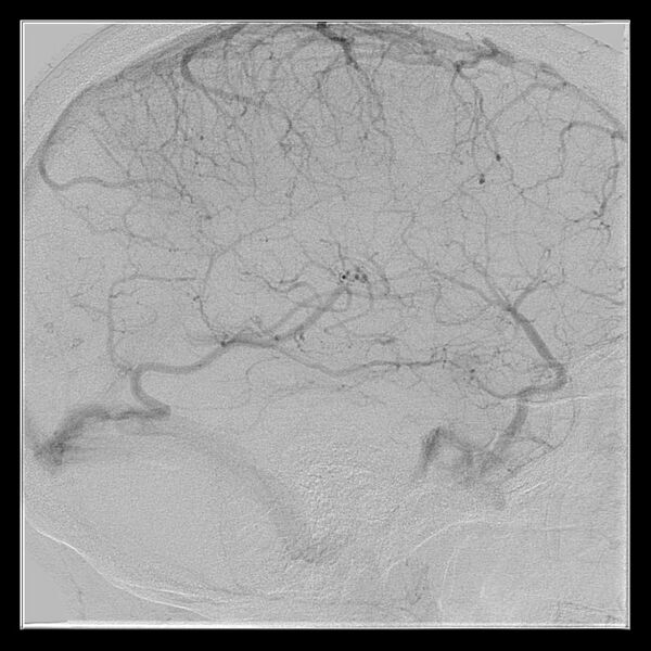 File:Cerebral aneurysm with rupture (Radiopaedia 29933-30458 LT CCA IC 47).jpg