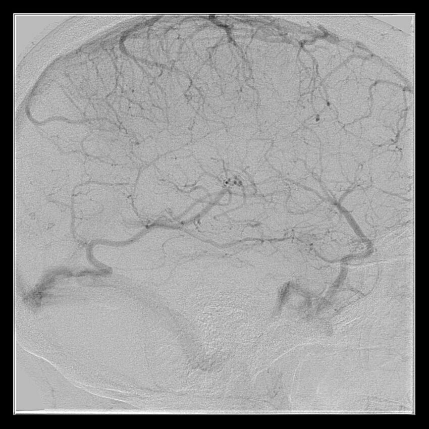 Cerebral aneurysm with rupture (Radiopaedia 29933-30458 LT CCA IC 47).jpg