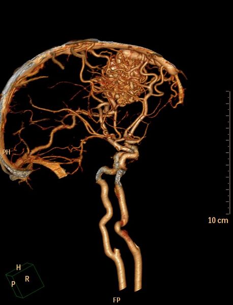 File:Cerebral arteriovenous malformation (Radiopaedia 29531-30031 B 7).jpg